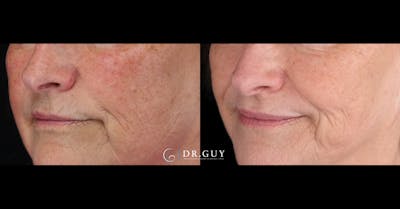 Laser Before & After Gallery - Patient 116711 - Image 1