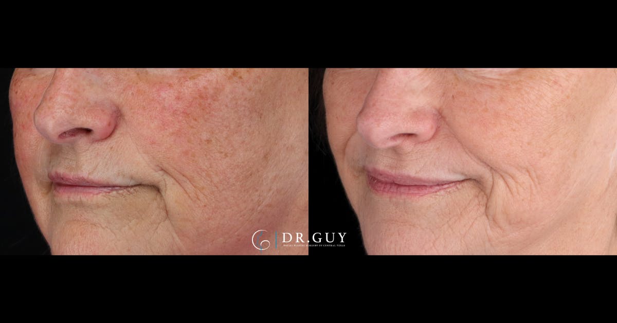 Laser Before & After Gallery - Patient 116711 - Image 1