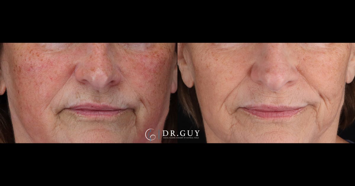 Laser Before & After Gallery - Patient 116711 - Image 2
