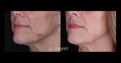 Scar Revision Before & After Gallery - Patient 165779 - Image 1
