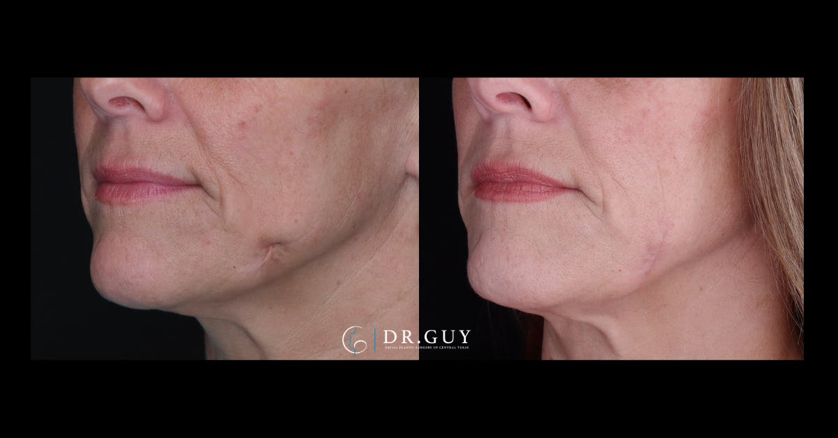 Scar Revision Before & After Gallery - Patient 165779 - Image 1