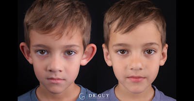 Otoplasty Before & After Gallery - Patient 217522 - Image 1