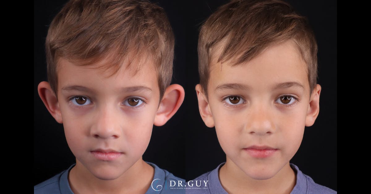 Otoplasty Before & After Gallery - Patient 217522 - Image 1