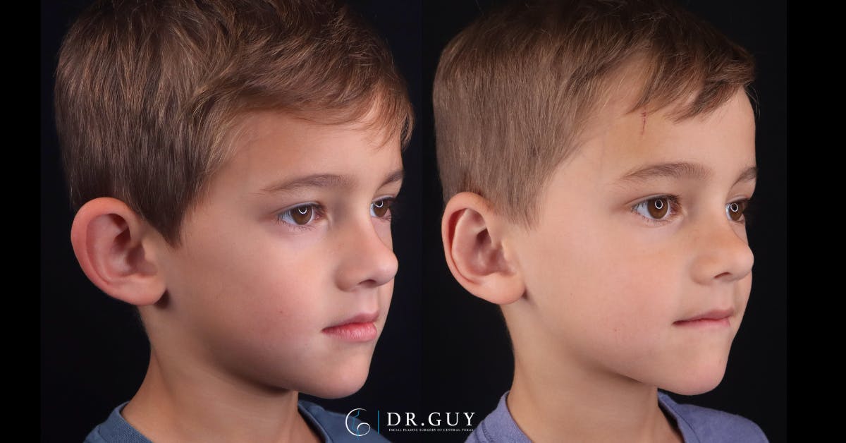 Otoplasty Before & After Gallery - Patient 217522 - Image 2