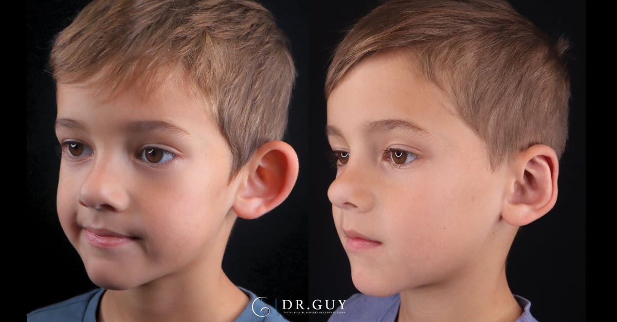 Otoplasty Before & After Gallery - Patient 217522 - Image 3