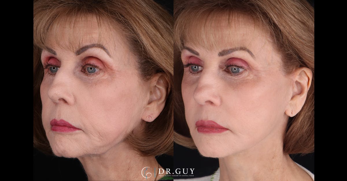 Mini Facelift Before & After Gallery - Patient 360663 - Image 1