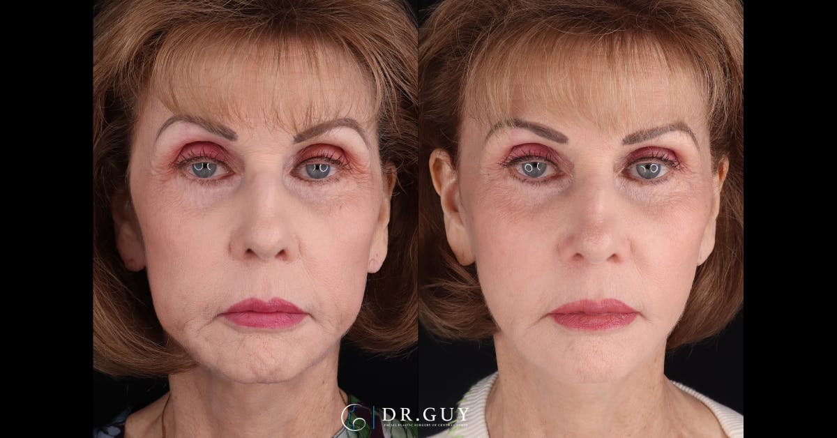 Mini Facelift Before & After Gallery - Patient 360663 - Image 3