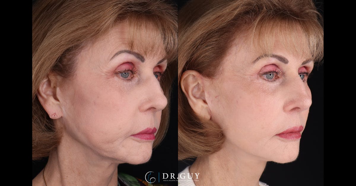 Mini Facelift Before & After Gallery - Patient 360663 - Image 2