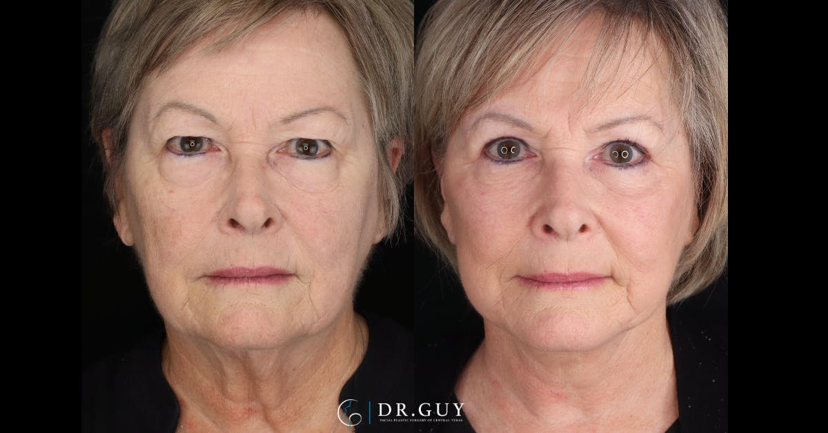 Facelift Before & After Gallery - Patient 367267 - Image 1