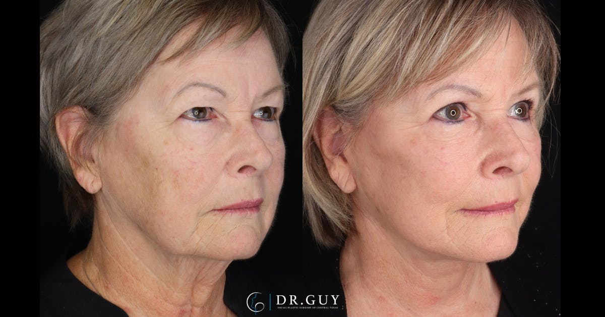Facelift Before & After Gallery - Patient 367267 - Image 2