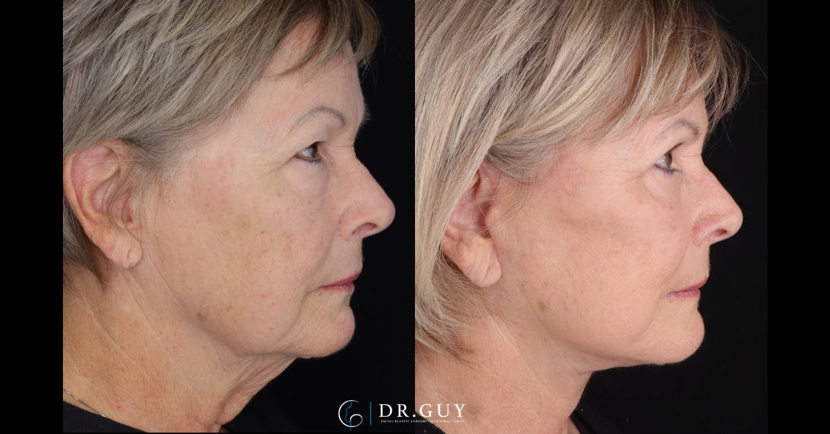 Facelift Before & After Gallery - Patient 367267 - Image 3