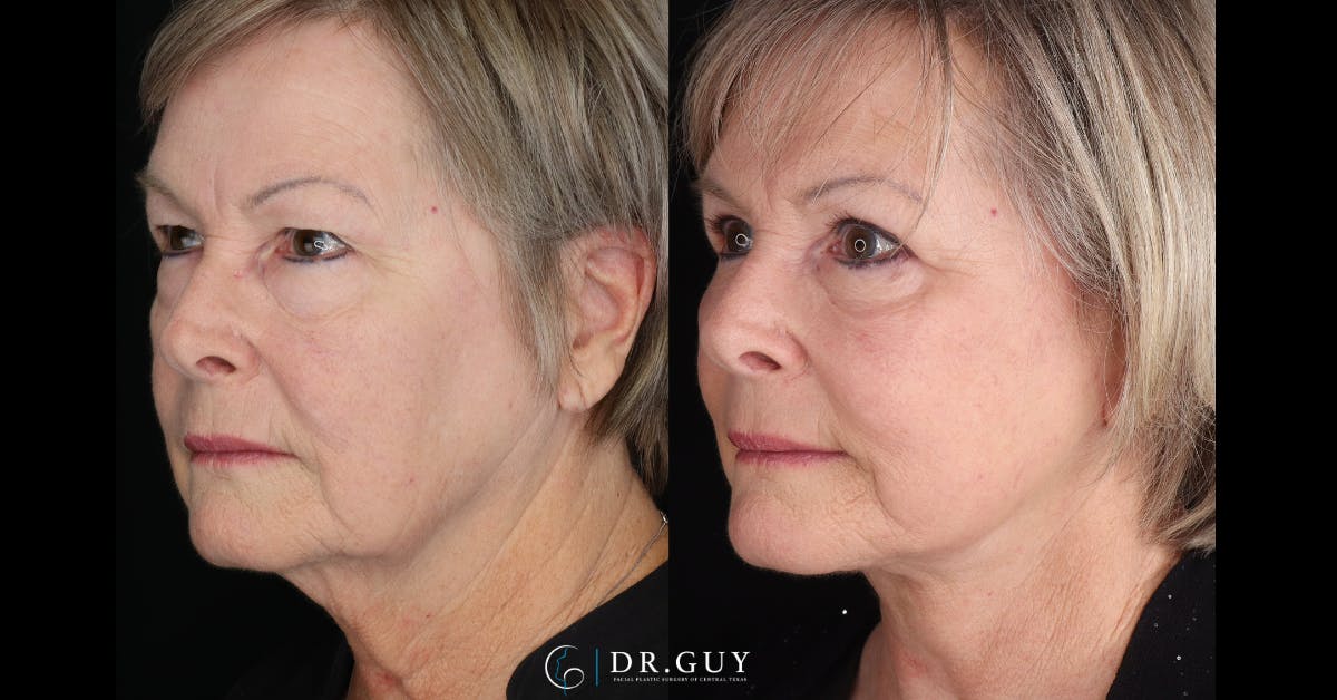 Facelift Before & After Gallery - Patient 367267 - Image 4