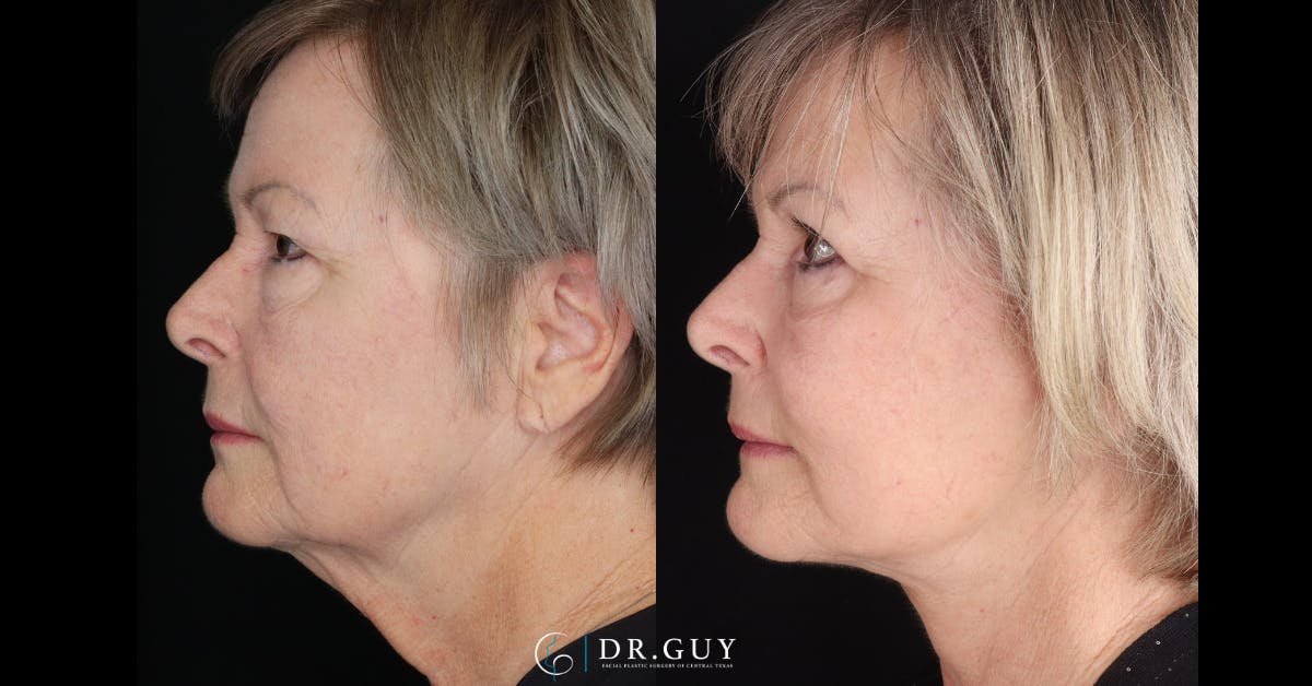 Facelift Before & After Gallery - Patient 367267 - Image 5