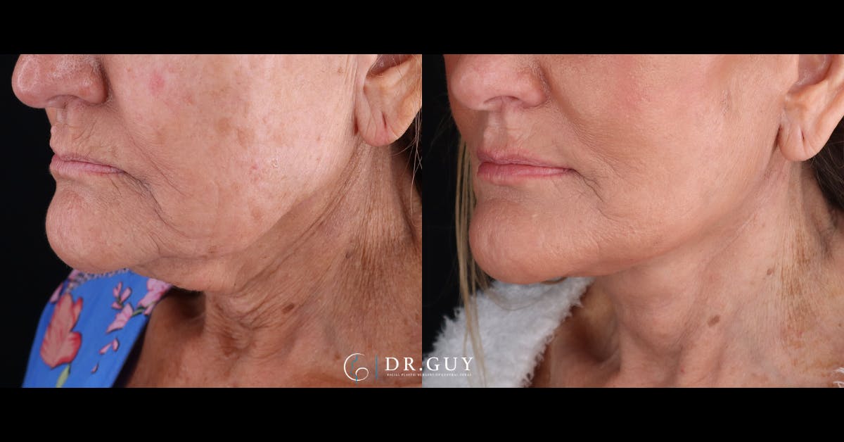 Facelift Before & After Gallery - Patient 223603 - Image 2