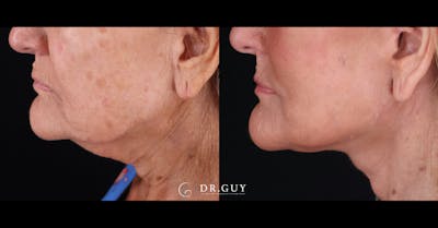 Facelift Before & After Gallery - Patient 223603 - Image 1