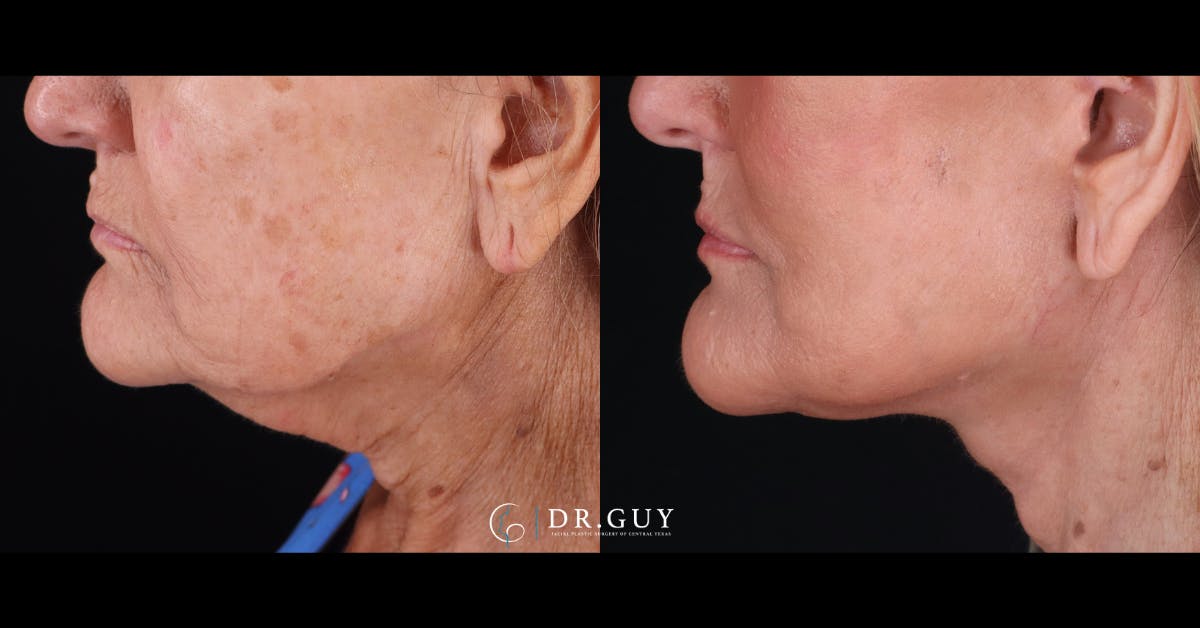 Facelift Before & After Gallery - Patient 223603 - Image 1
