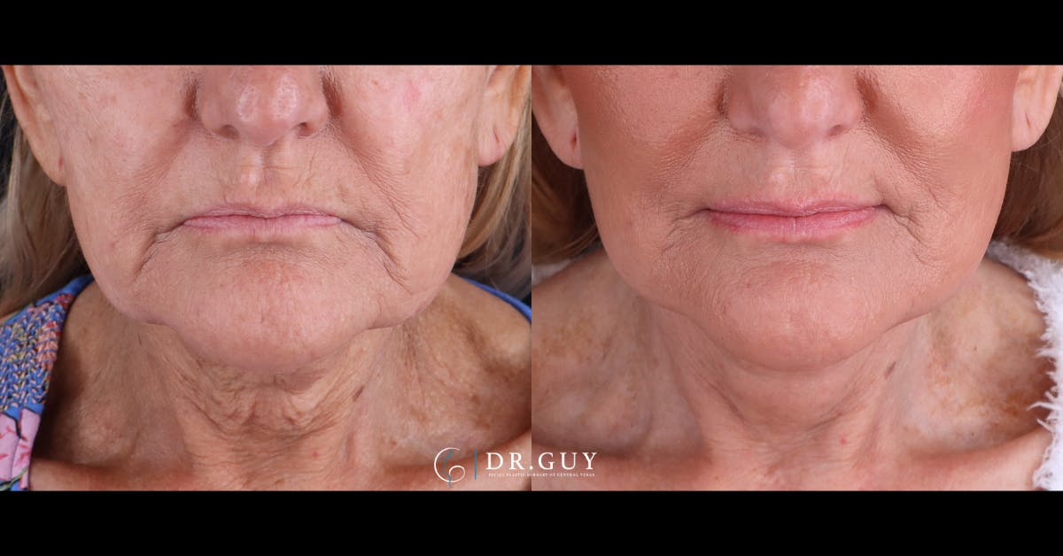 Facelift Before & After Gallery - Patient 223603 - Image 5