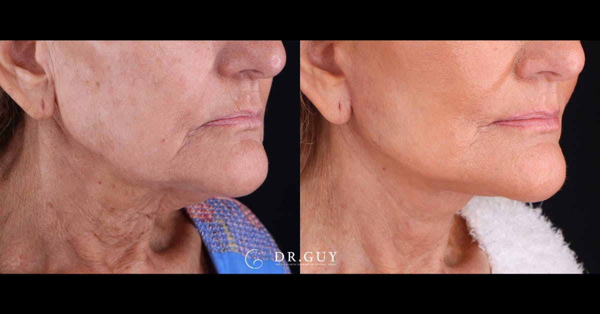 Facelift Before & After Gallery - Patient 223603 - Image 3