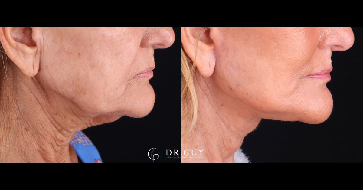 Facelift Before & After Gallery - Patient 223603 - Image 4