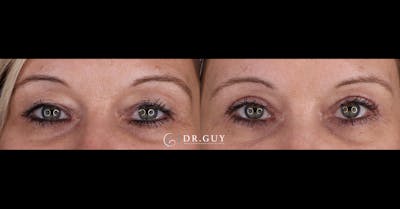 Upper Blepharoplasty Before & After Gallery - Patient 402287 - Image 1