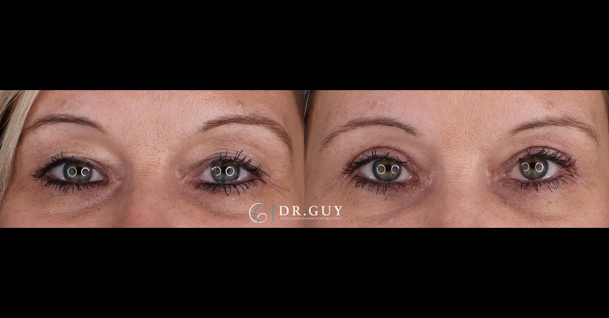 Upper Blepharoplasty Before & After Gallery - Patient 402287 - Image 1