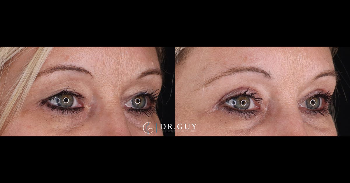 Upper Blepharoplasty Before & After Gallery - Patient 402287 - Image 2