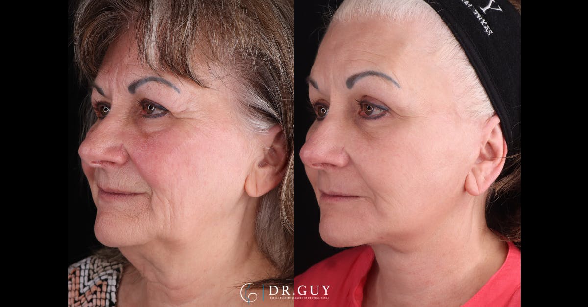 Lower Blepharoplasty Before & After Gallery - Patient 314390 - Image 4