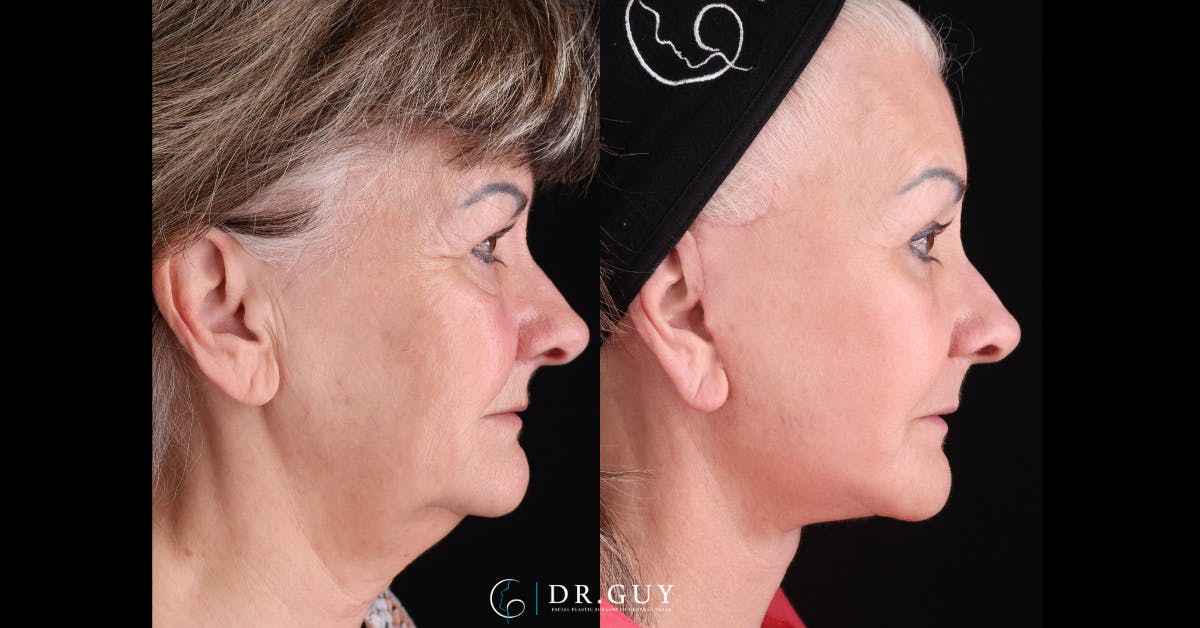 Lower Blepharoplasty Before & After Gallery - Patient 314390 - Image 3