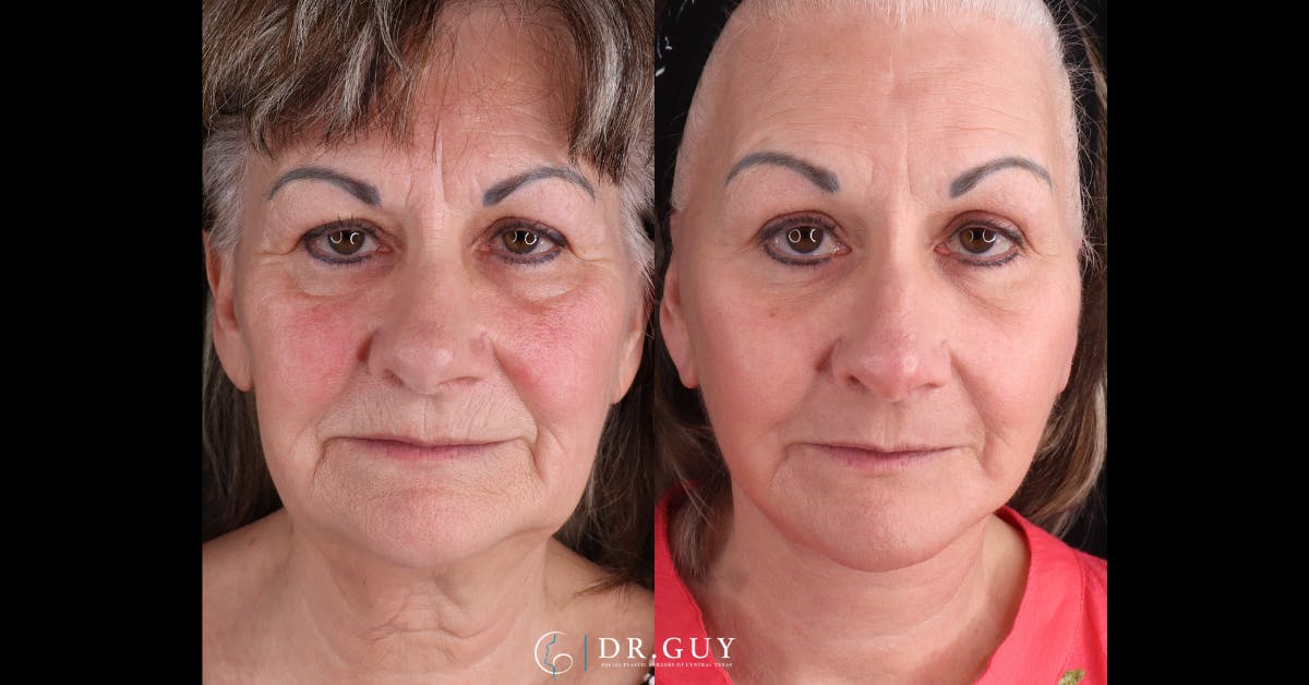 Lower Blepharoplasty Before & After Gallery - Patient 314390 - Image 1