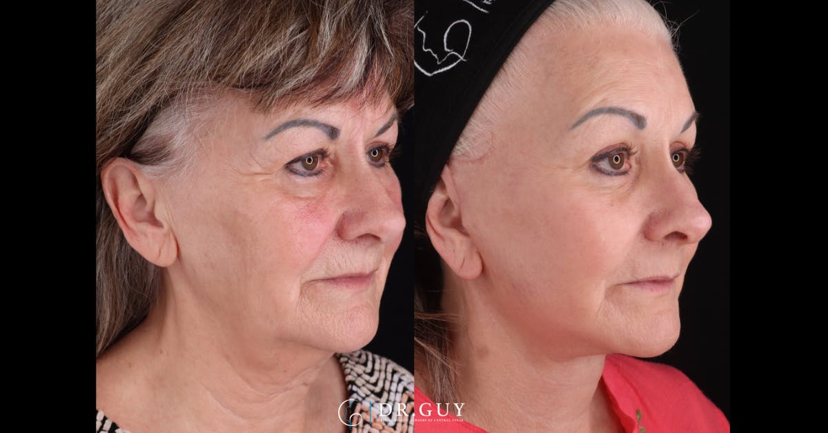 Lower Blepharoplasty Before & After Gallery - Patient 314390 - Image 2