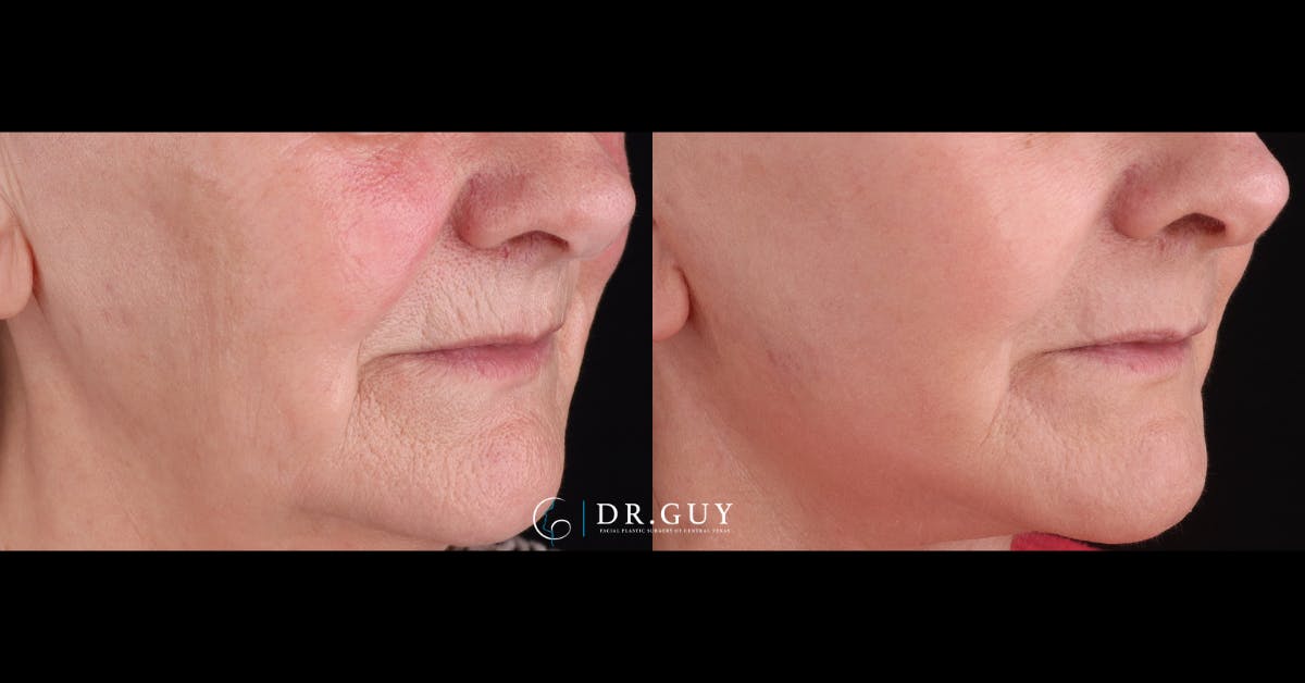 Laser Before & After Gallery - Patient 926567 - Image 2
