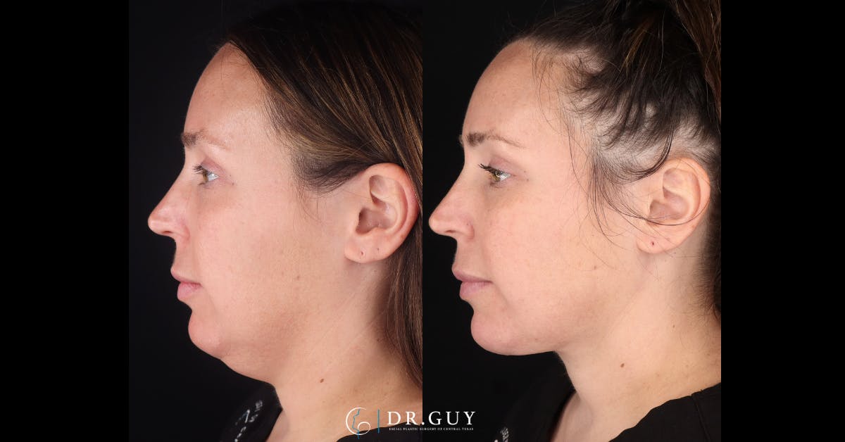 Platysmaplasty Before & After Gallery - Patient 269532 - Image 2