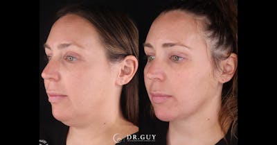 Platysmaplasty Before & After Gallery - Patient 269532 - Image 1