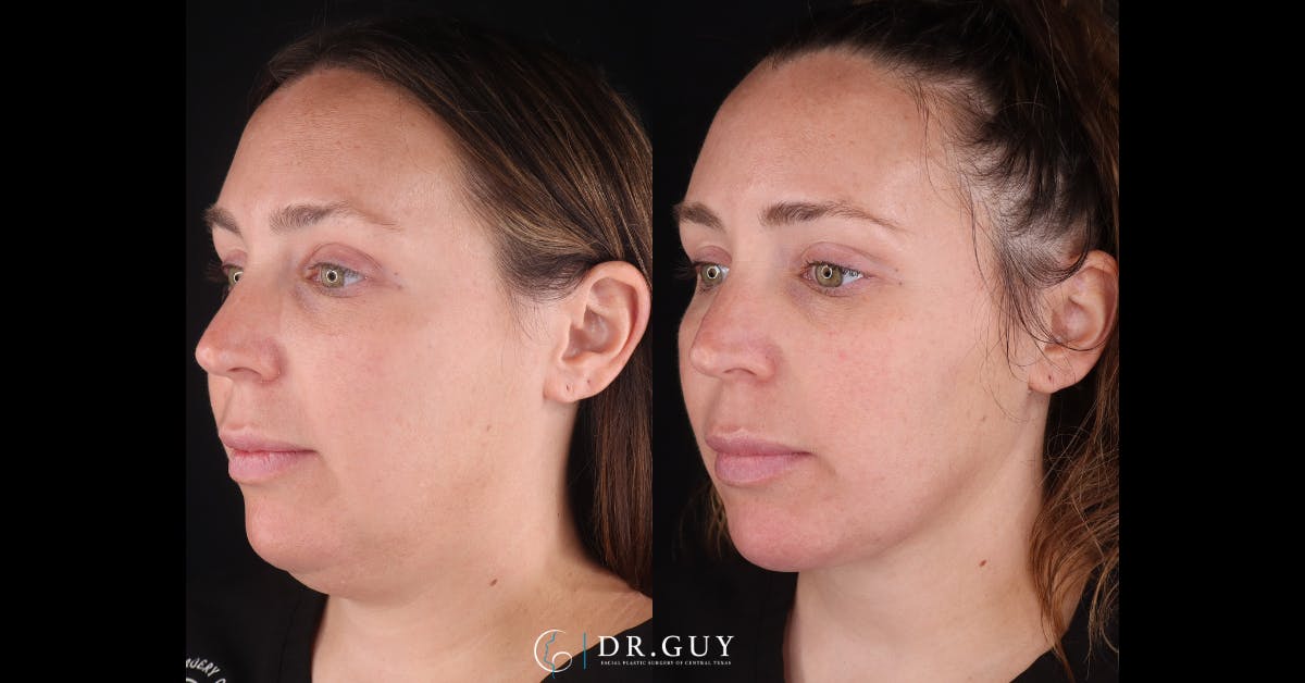 Platysmaplasty Before & After Gallery - Patient 269532 - Image 1