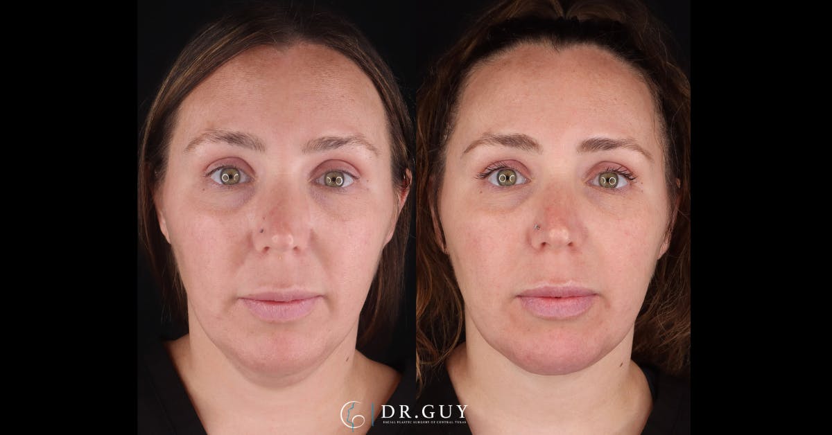 Platysmaplasty Before & After Gallery - Patient 269532 - Image 3