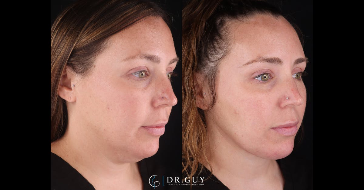 Platysmaplasty Before & After Gallery - Patient 269532 - Image 5