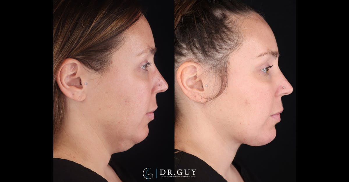 Platysmaplasty Before & After Gallery - Patient 269532 - Image 4