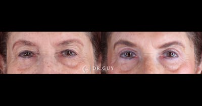 Upper Blepharoplasty Before & After Gallery - Patient 419815 - Image 1