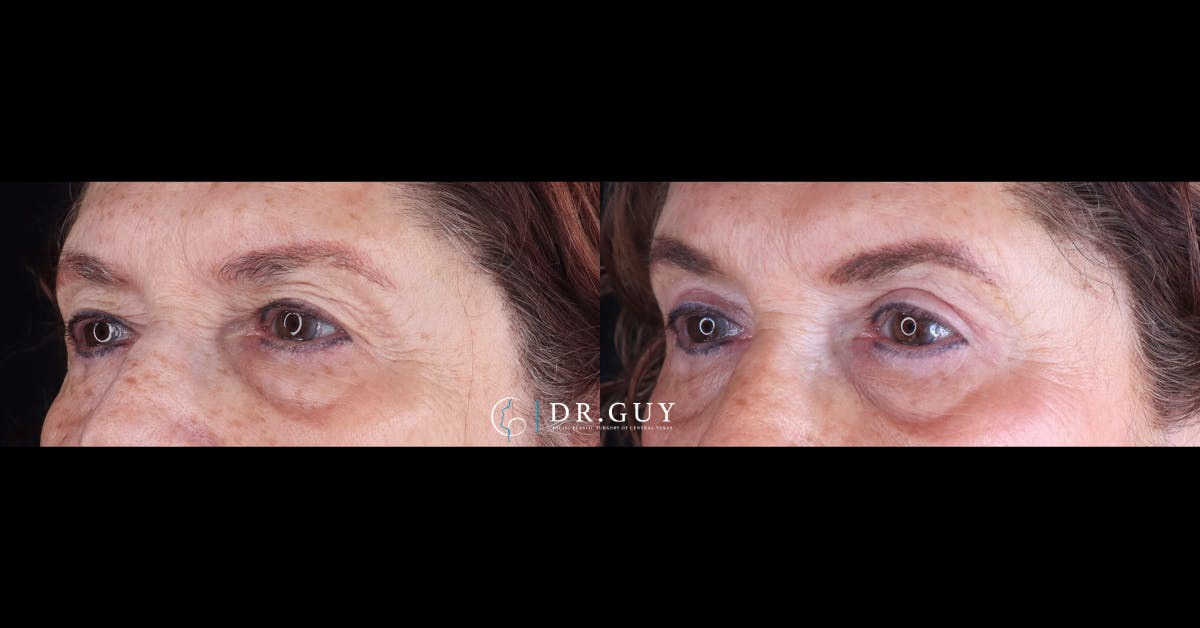 Upper Blepharoplasty Before & After Gallery - Patient 419815 - Image 3