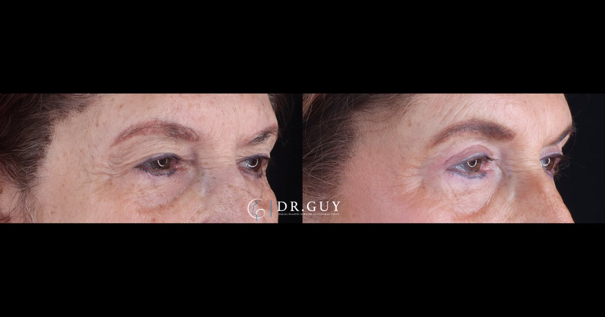 Upper Blepharoplasty Before & After Gallery - Patient 419815 - Image 2