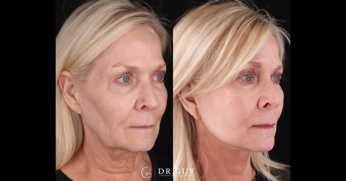 Mini Facelift Before & After Gallery - Patient 417641 - Image 4