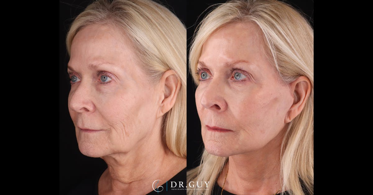 Mini Facelift Before & After Gallery - Patient 417641 - Image 2