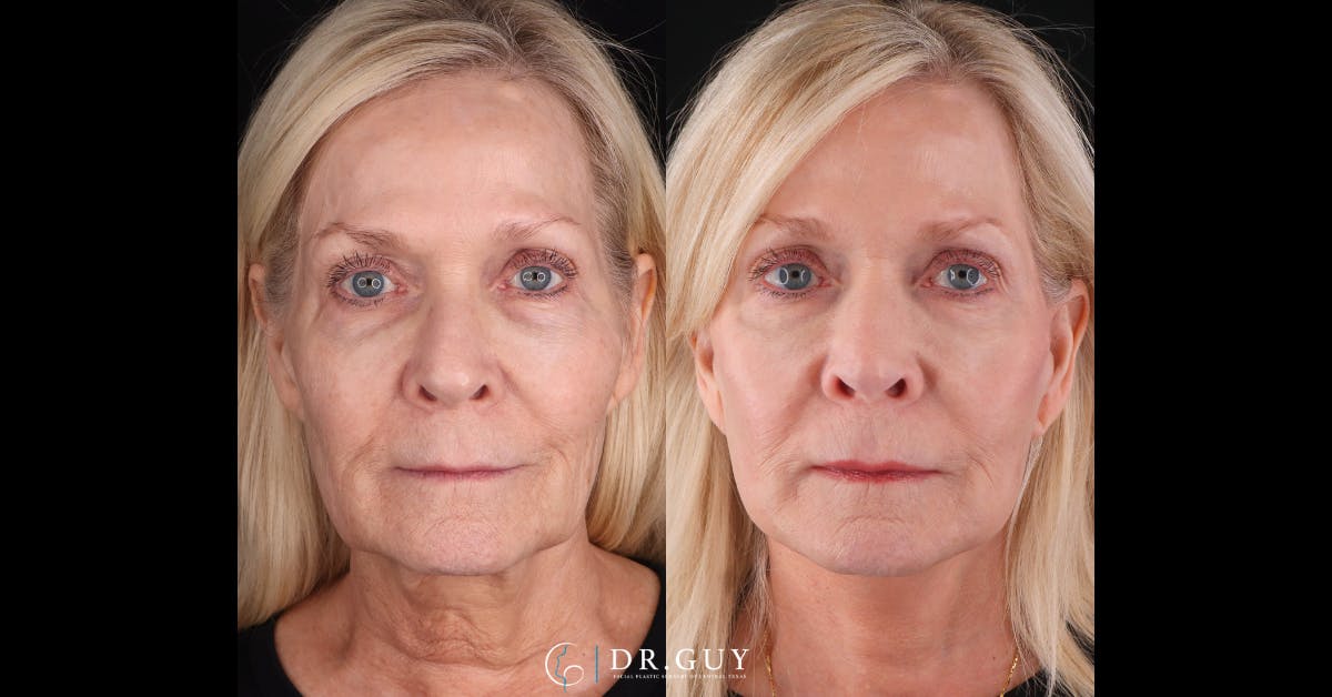 Mini Facelift Before & After Gallery - Patient 417641 - Image 1