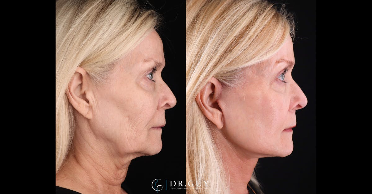 Mini Facelift Before & After Gallery - Patient 417641 - Image 5