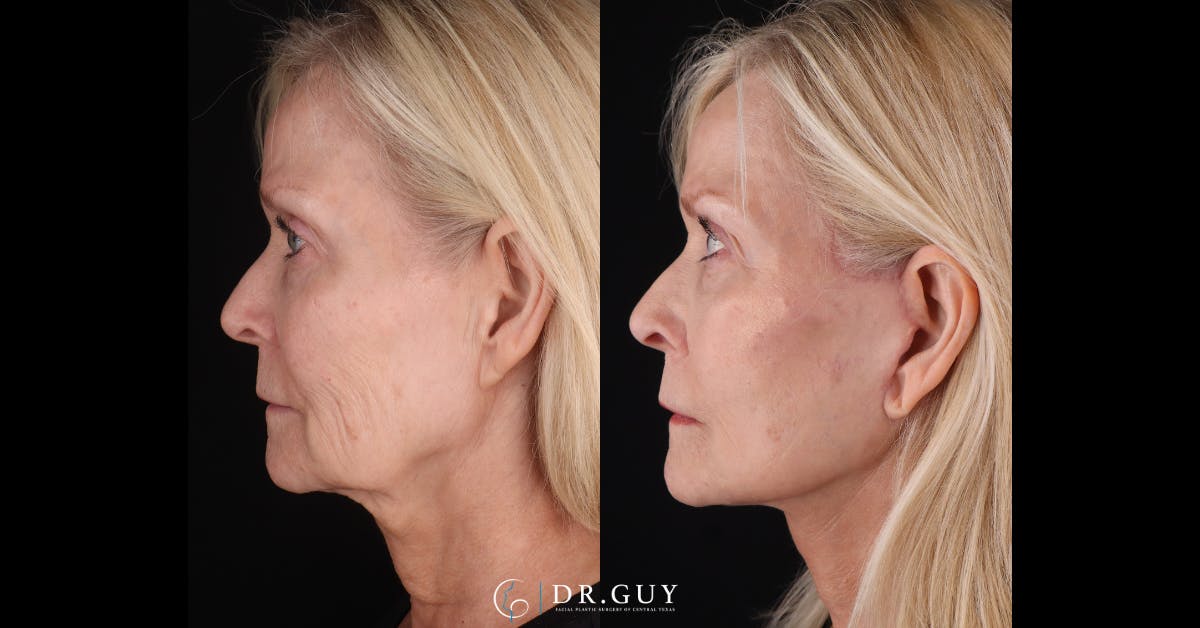 Mini Facelift Before & After Gallery - Patient 417641 - Image 3
