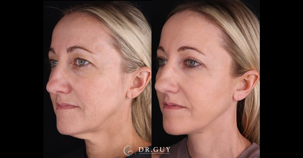 Neck Lift Before & After Gallery - Patient 105029 - Image 1