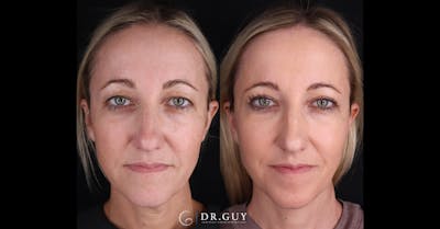 Upper Blepharoplasty Before & After Gallery - Patient 191046 - Image 1
