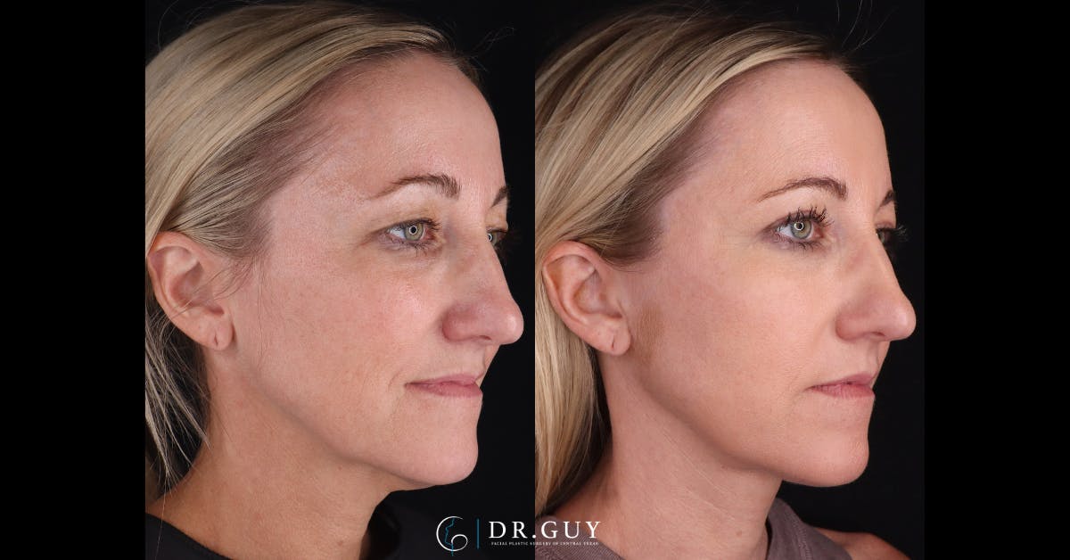 Neck Lift Before & After Gallery - Patient 105029 - Image 5