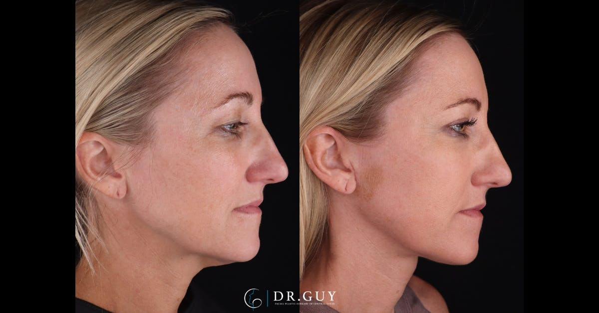 Neck Lift Before & After Gallery - Patient 105029 - Image 4