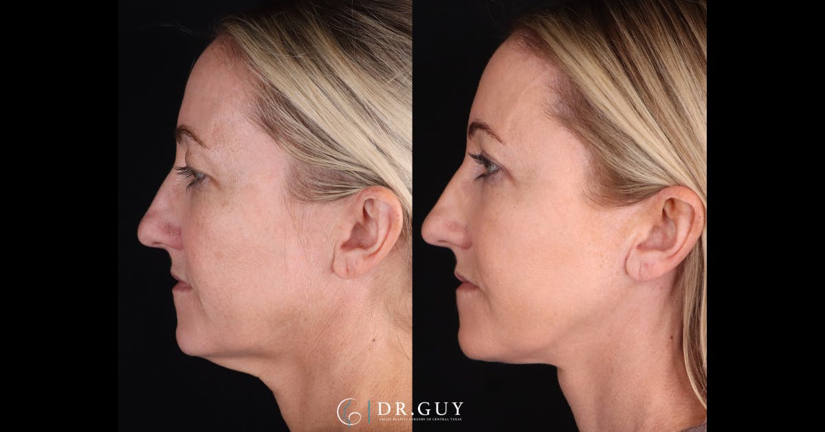 Neck Lift Before & After Gallery - Patient 105029 - Image 2